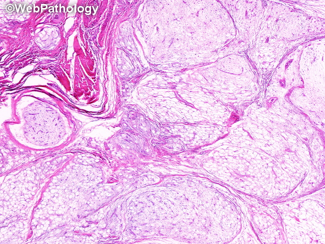 Soft Tissue_Lipomatous_Lipoblastoma13.jpg